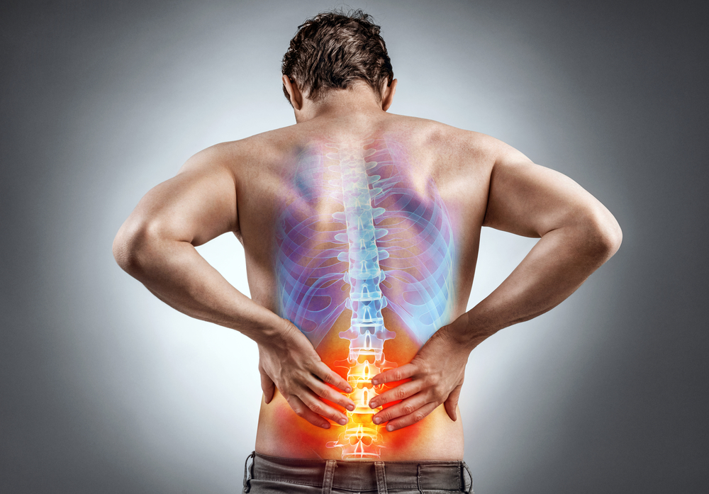 ankylosing spondylitis